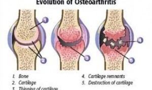 Obat Osteoarthritis Tanpa Operasi